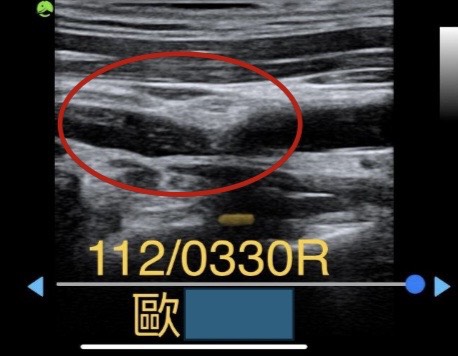 院長張長志醫師幸福專欄-頸動脈阻塞引起之嚴重頭暈失眠 我是不是快中風了 ? !